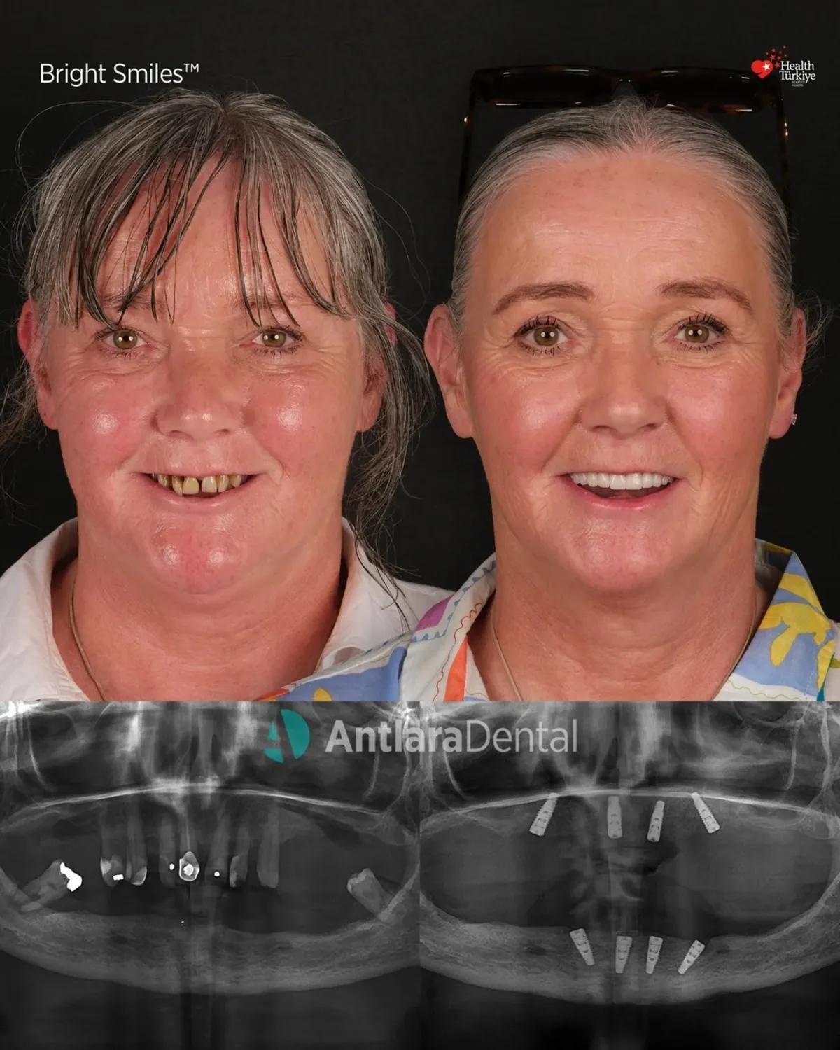 Before and after All-on-4 dental implants, patient one All-on-4 dental implants before and after with panoramic x-ray, patient one