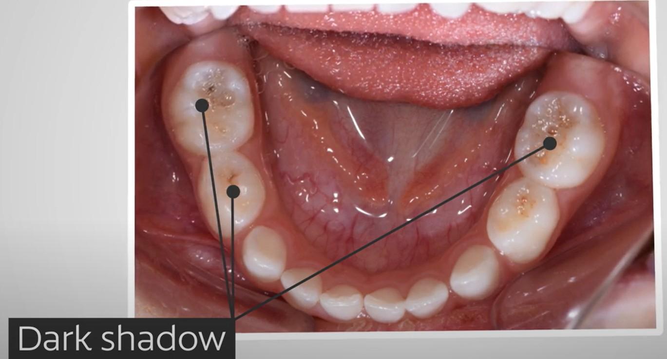 Dental Caries (Cavities)