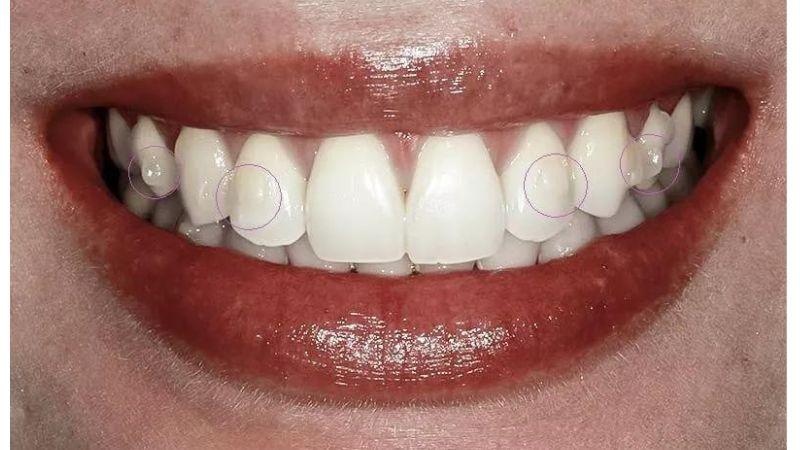 Smile with circled attachments on several teeth