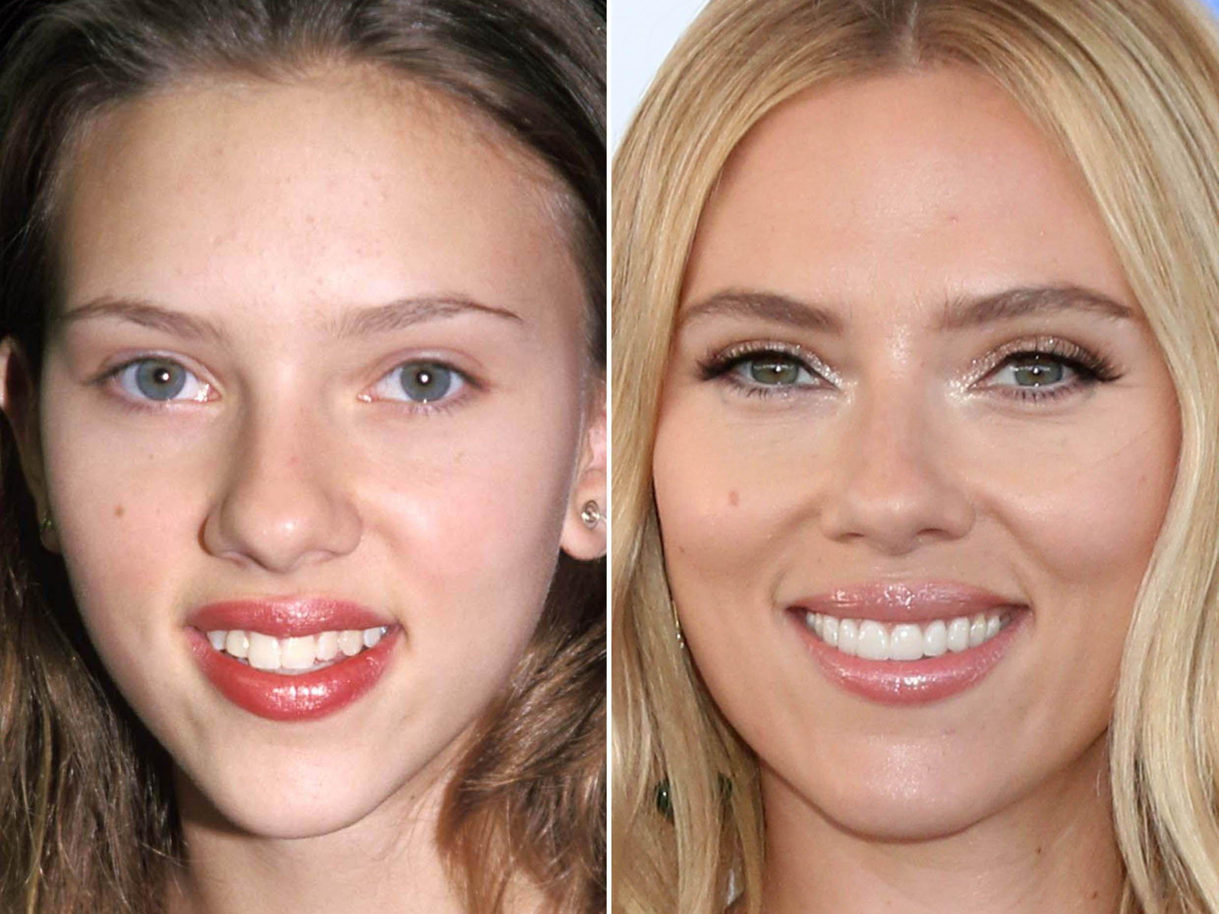 Scarlett-Johansson'ın diş kaplama tedavisi