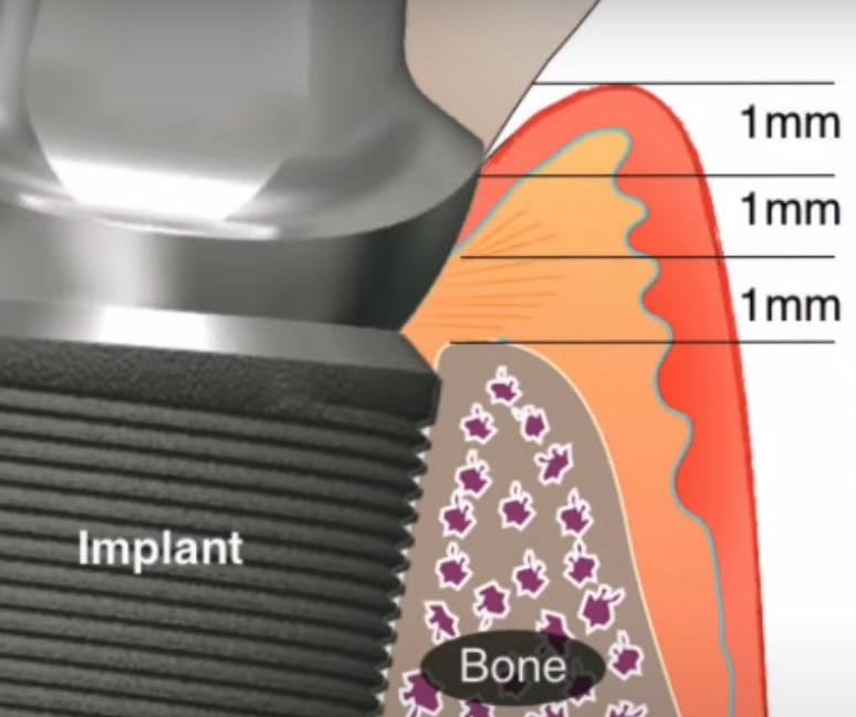 Cross-section of gum tissue and bone around an implant