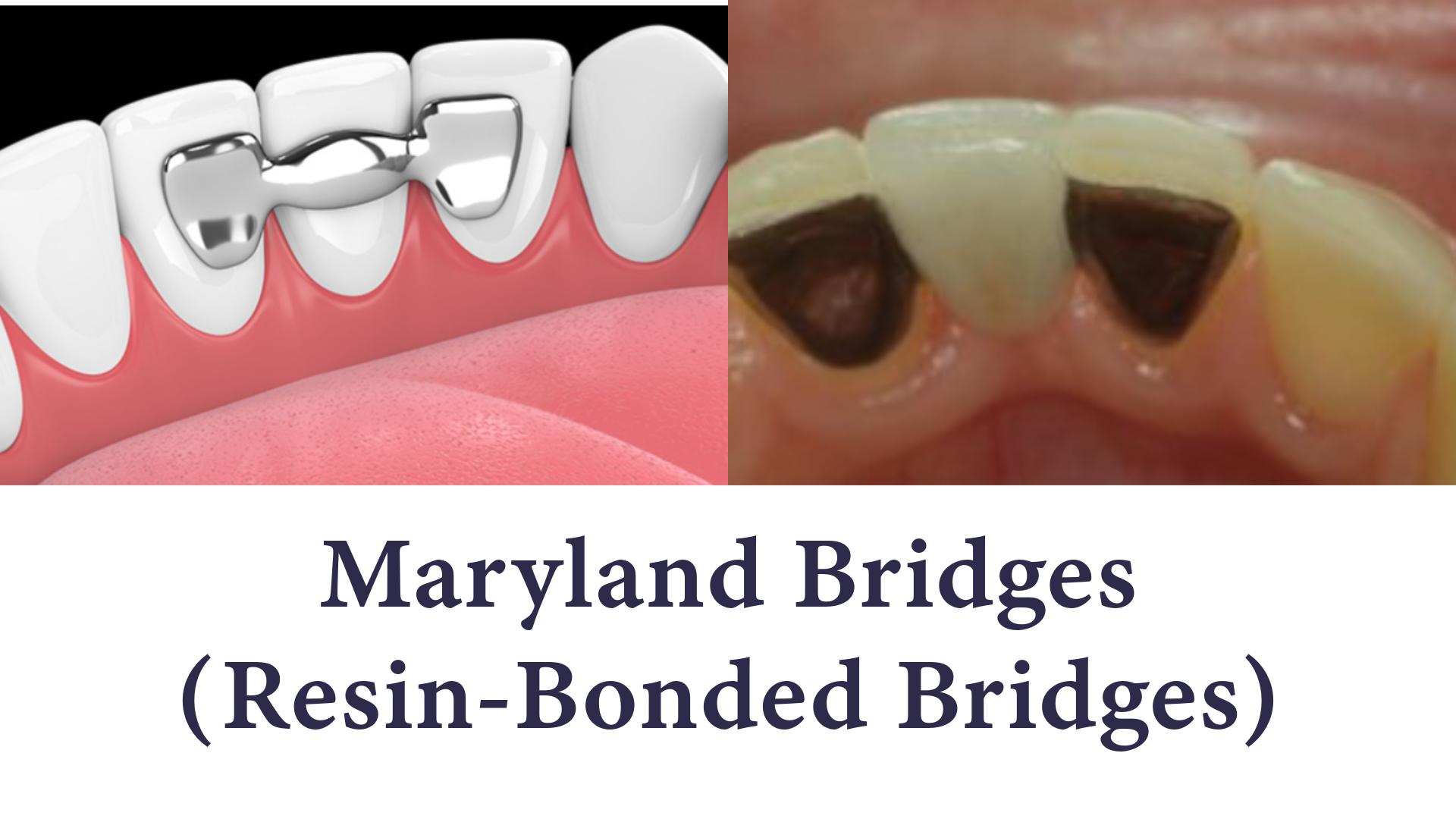 Resin-bonded bridge illustration and photo of metal wings on front teeth