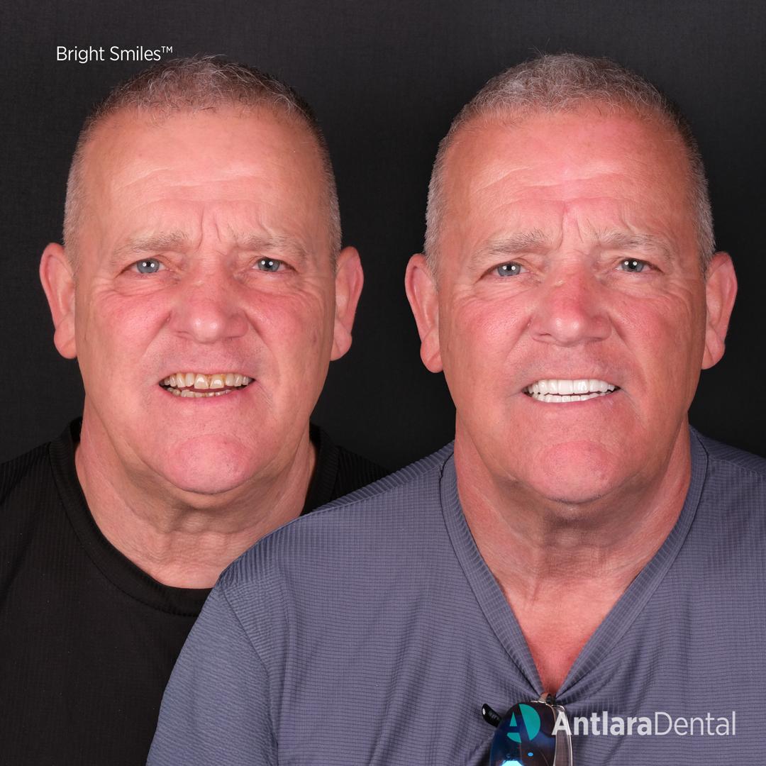 Turkey teeth before and after case