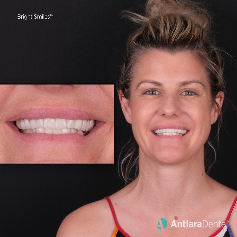 Woman smiling with a close-up of her white front teeth