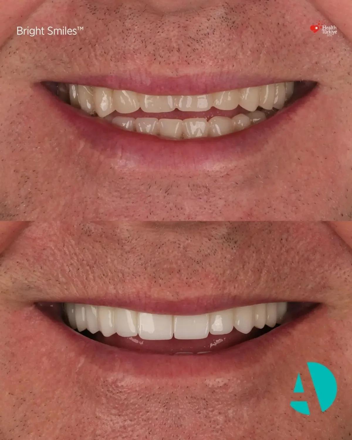 Close-up smile before and after, patient two Close-up smile before and after All-on-4 dental implants, patient two