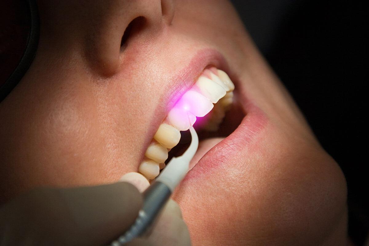 Pink laser light applied to a front tooth