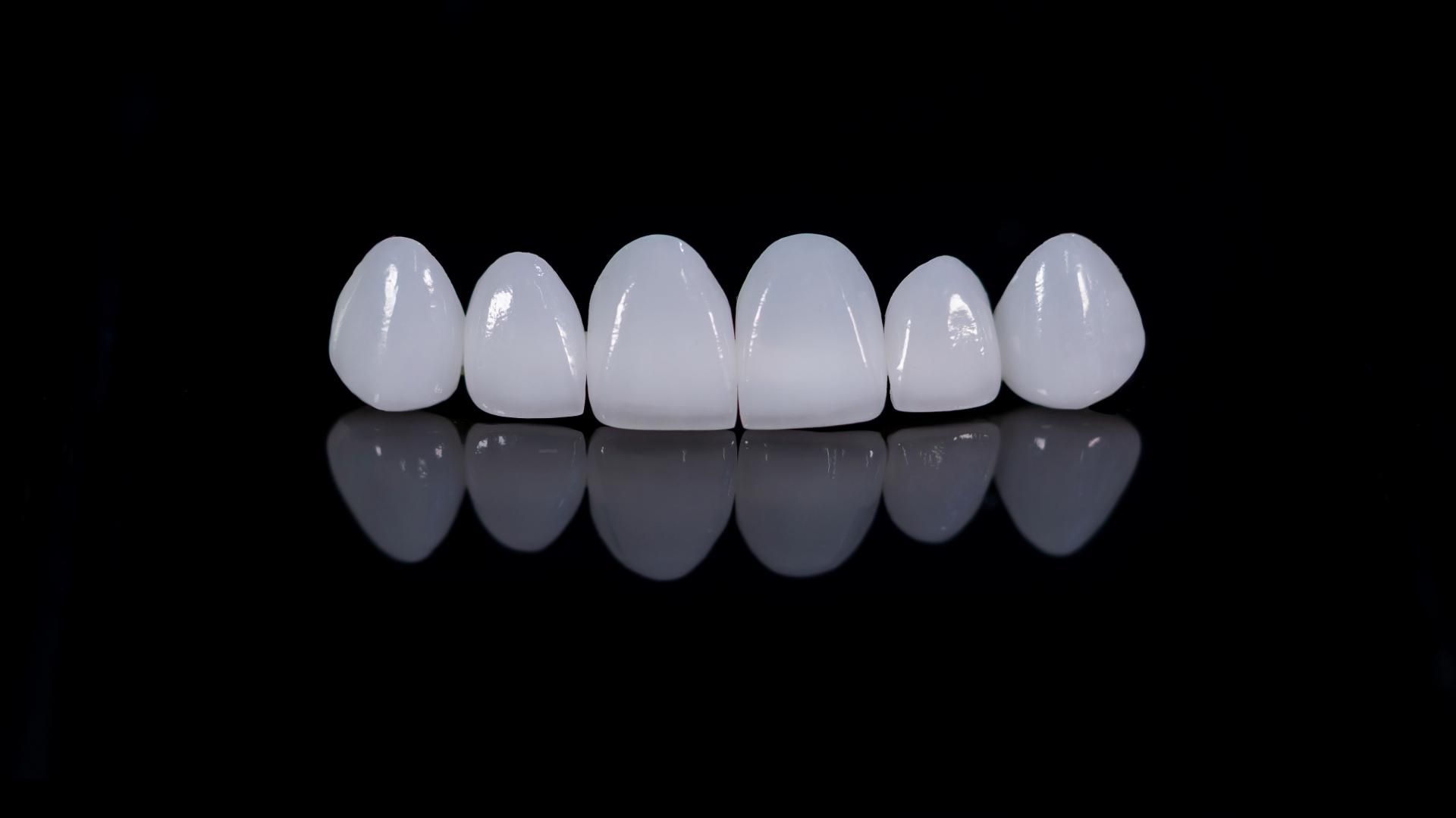 Six white ceramic veneers arranged in a row on a black surface