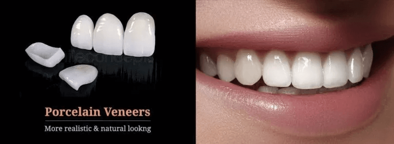 Porcelain veneers shown next to a close-up smile