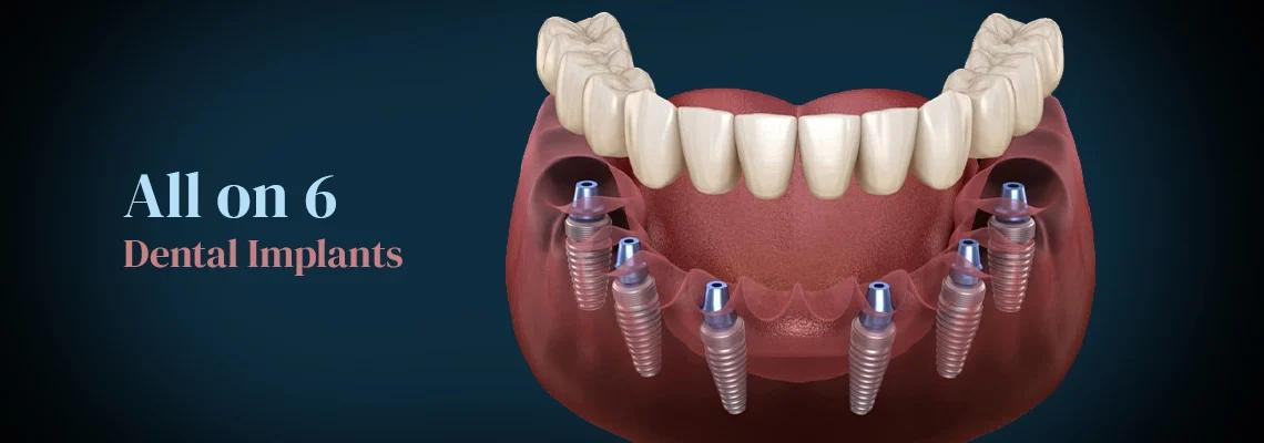 Rendering of six implants supporting a full lower arch of teeth