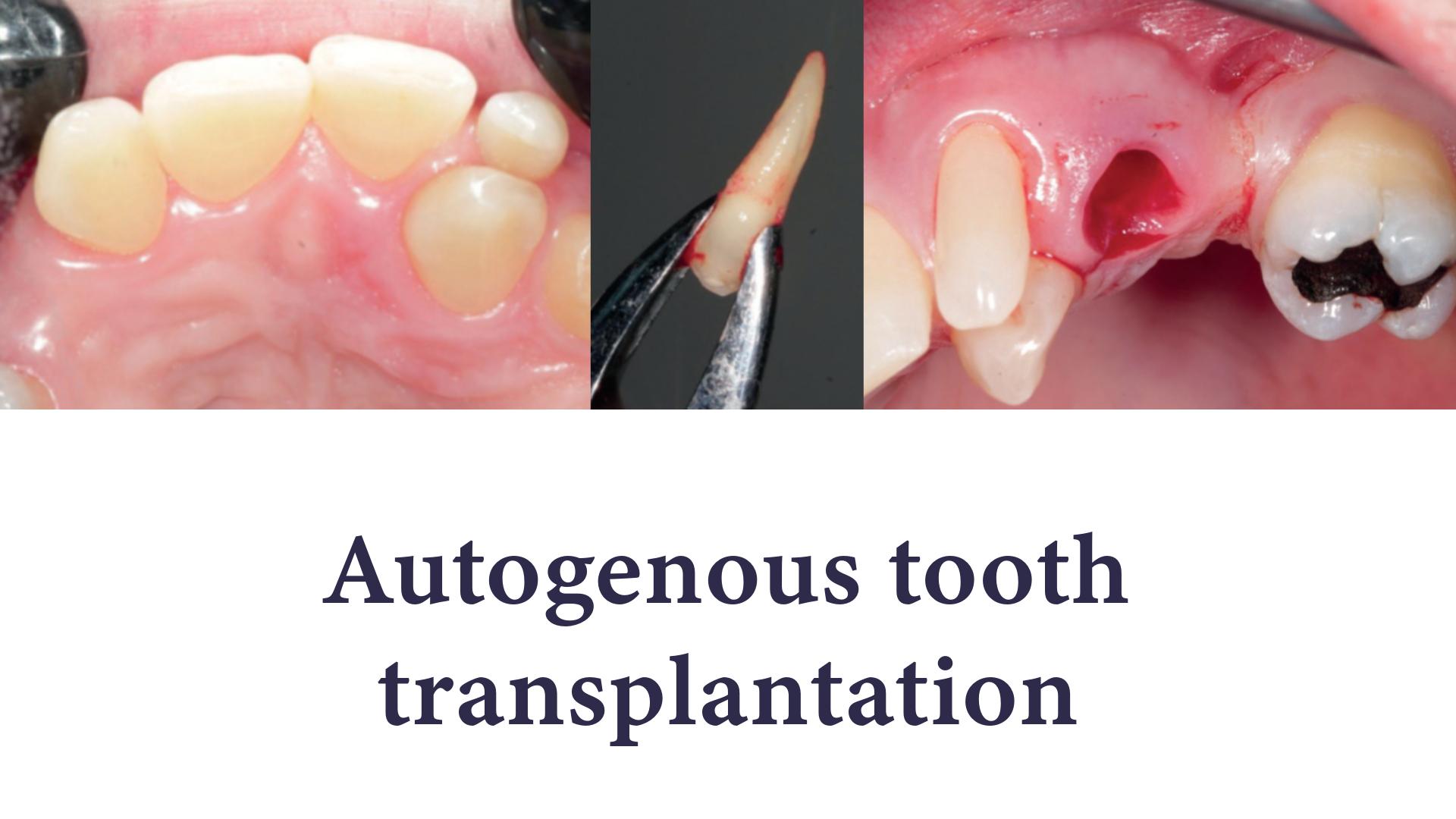 Steps of autogenous tooth transplantation