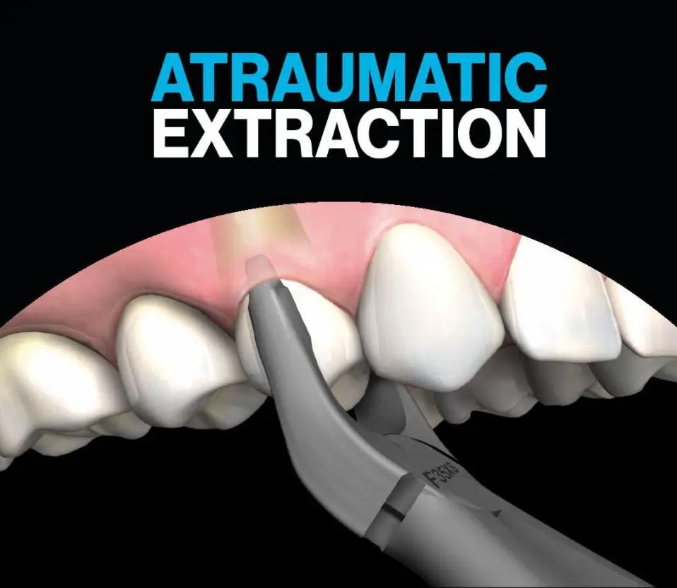 Illustration of atraumatic extraction of a front tooth with forceps