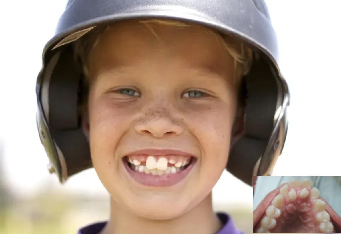 Smiling boy in a helmet with an inset of extra upper teeth