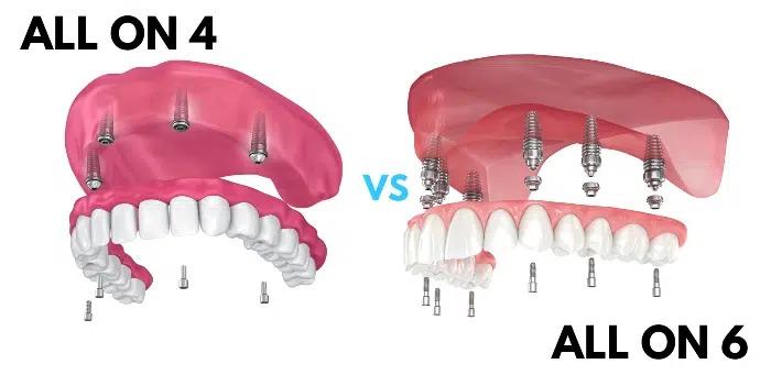 Illustration comparing All-on-4 and All-on-6 implant bridges