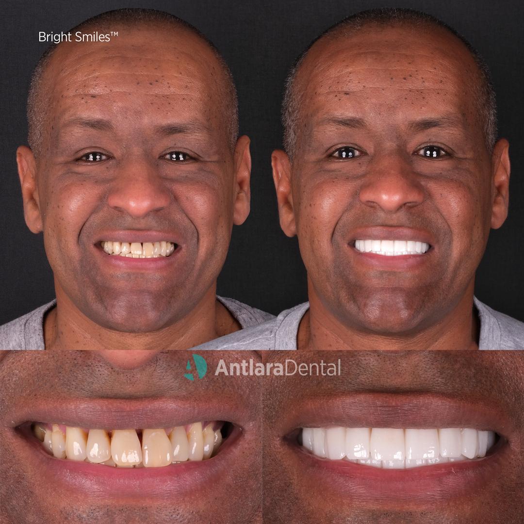 Turkey teeth before and after case