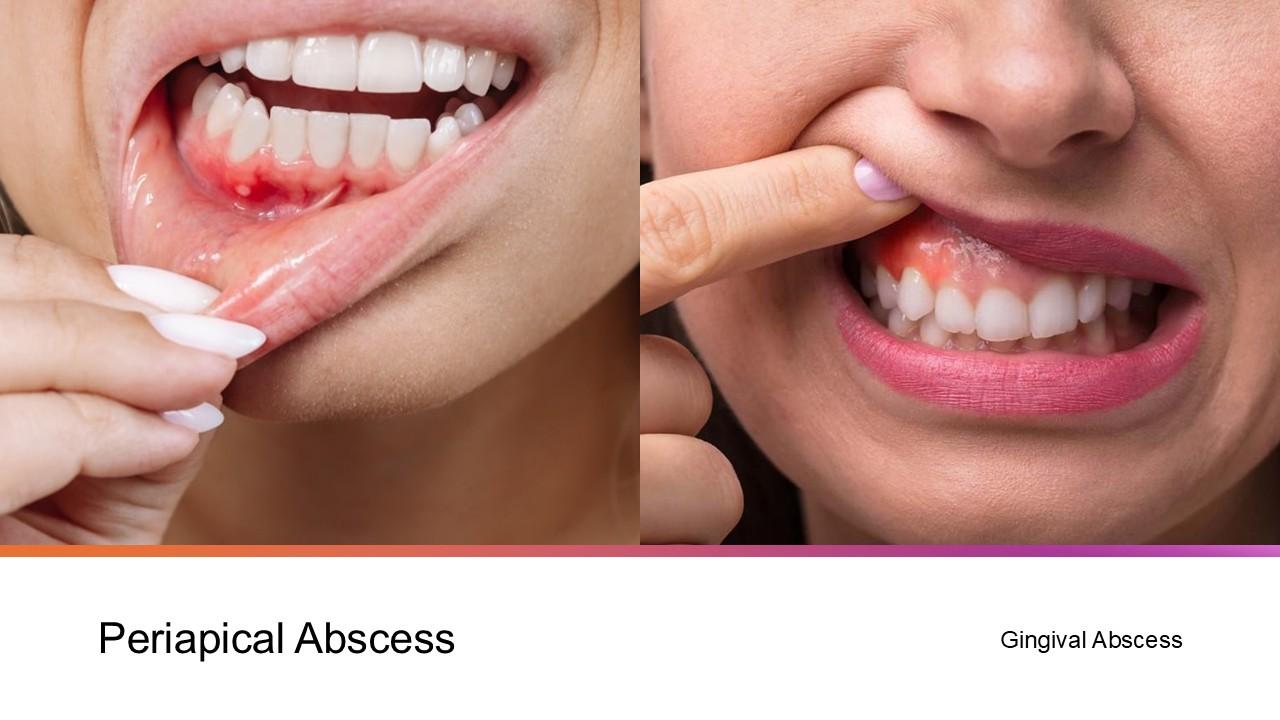 Why No Dairy After Tooth Extraction?