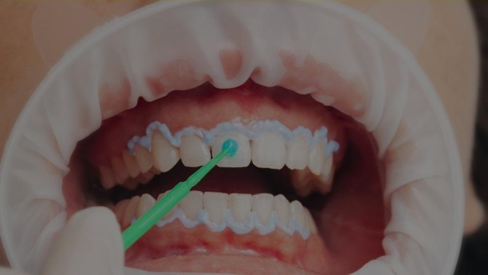 Hydrogen Peroxide for Teeth Whitening