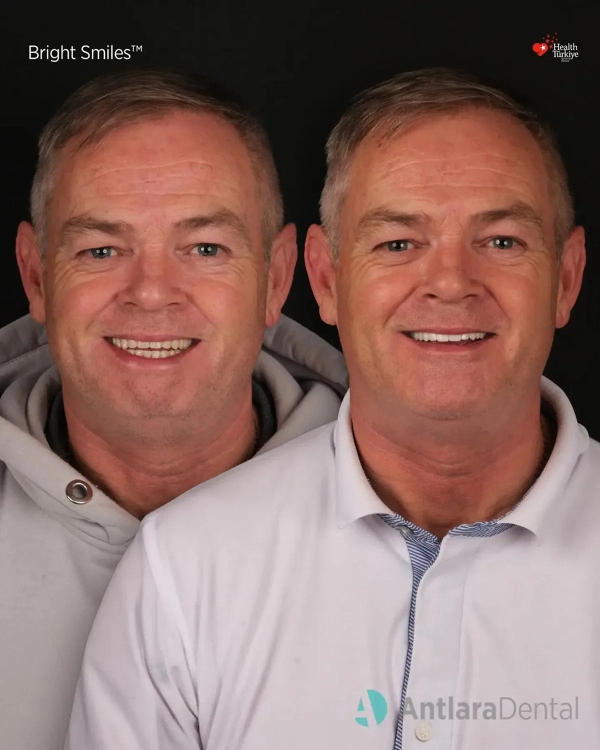 Before and after portrait, patient two All-on-4 dental implants before and after portrait, patient two