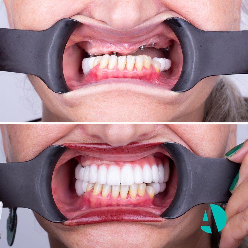 Before & after all-on-six all on 6 implant