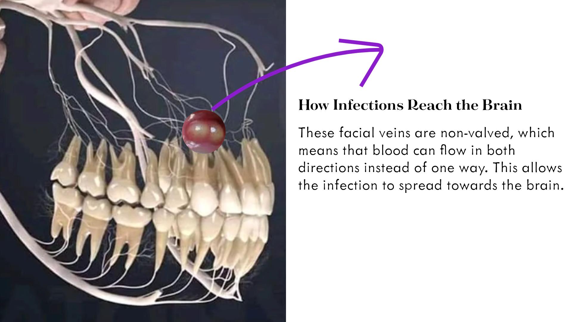 Teeth with facial veins and a text note on how infection reaches the brain