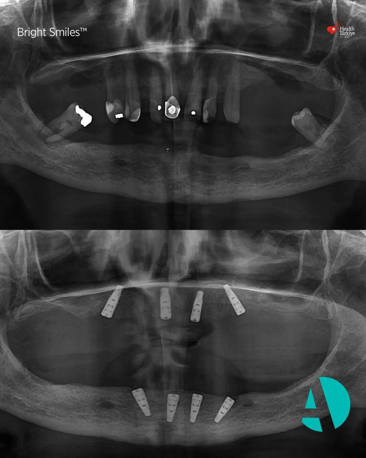 Panoramic x-ray before and after, patient one Panoramic x-ray before and after All-on-4 dental implants, patient one