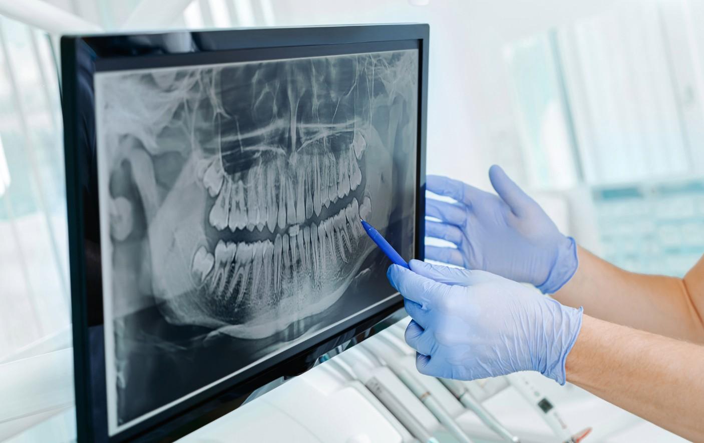 Diagnosing Black Dots on Teeth