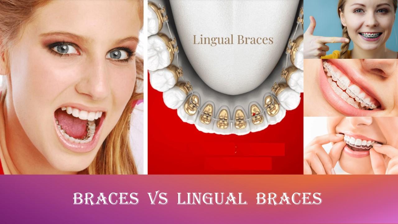 Collage of lingual braces, front braces and a clear aligner