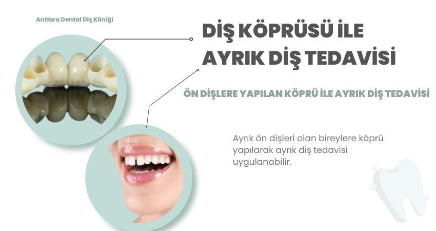 Diş köprüsü modeli ve araları açık ön dişleri gösteren slayt