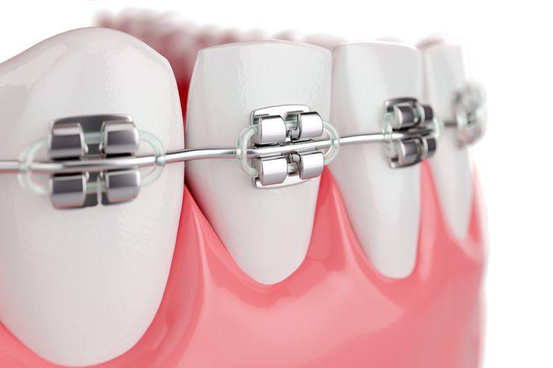 Model of teeth with metal brackets and an archwire