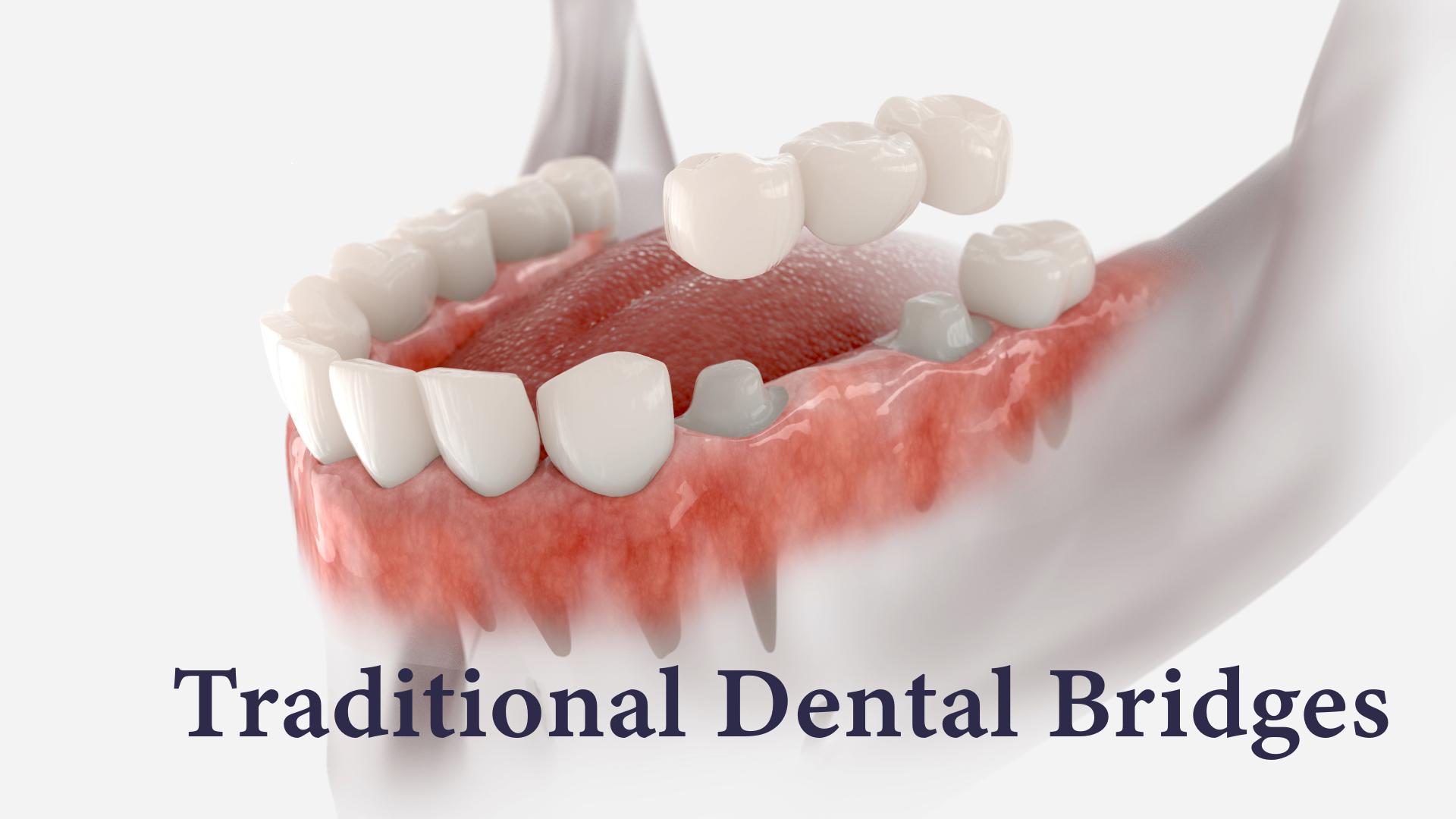 3D illustration of a fixed dental bridge above prepared teeth