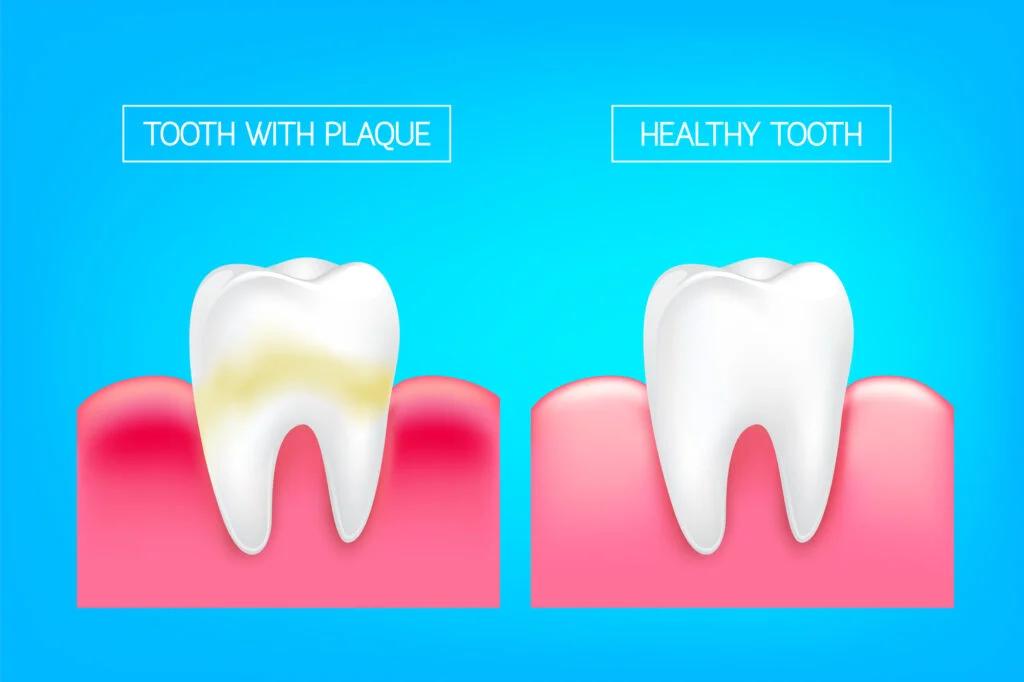 Illustration of a tooth with plaque beside a healthy tooth