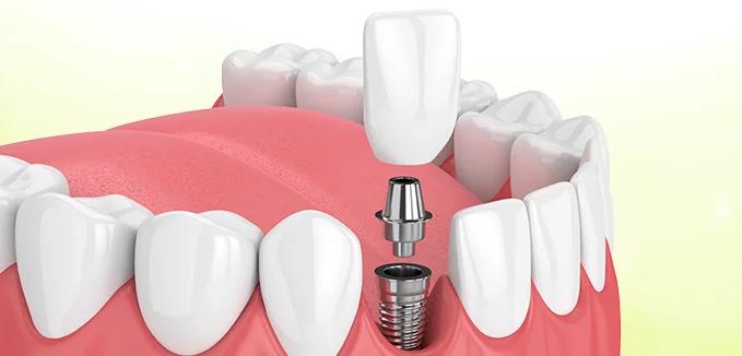 Crown with implant support