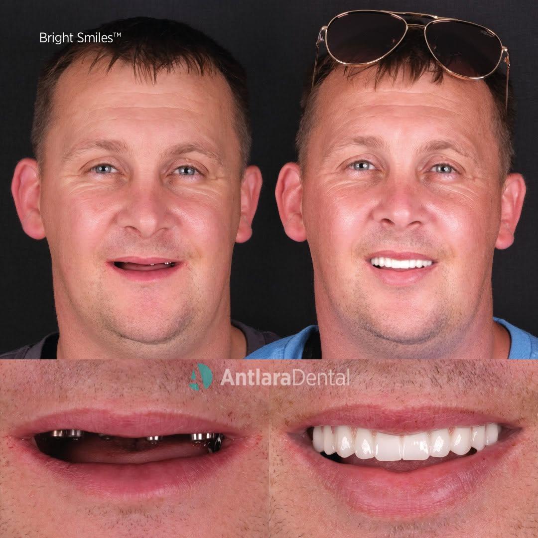 All on 6 dental implants before and after All on 6 dental implants before and after