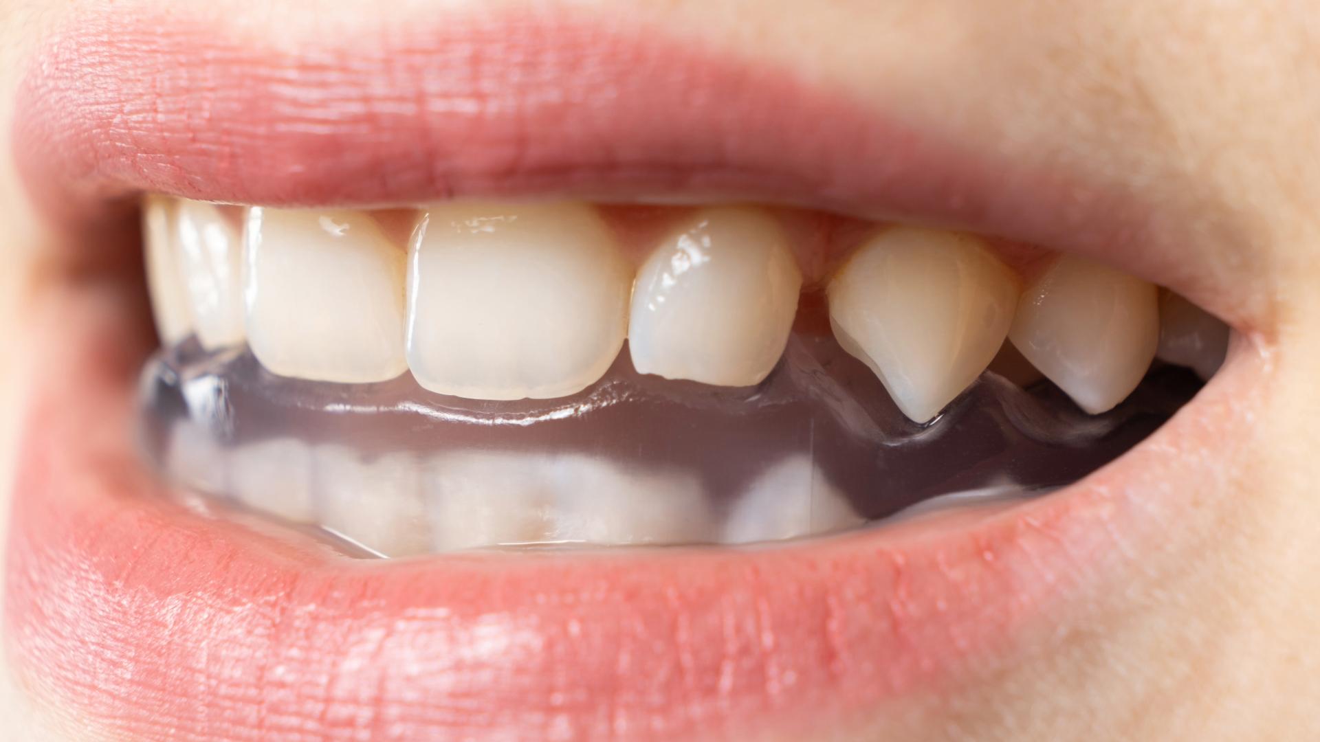 Close-up of a clear mouthguard over the teeth