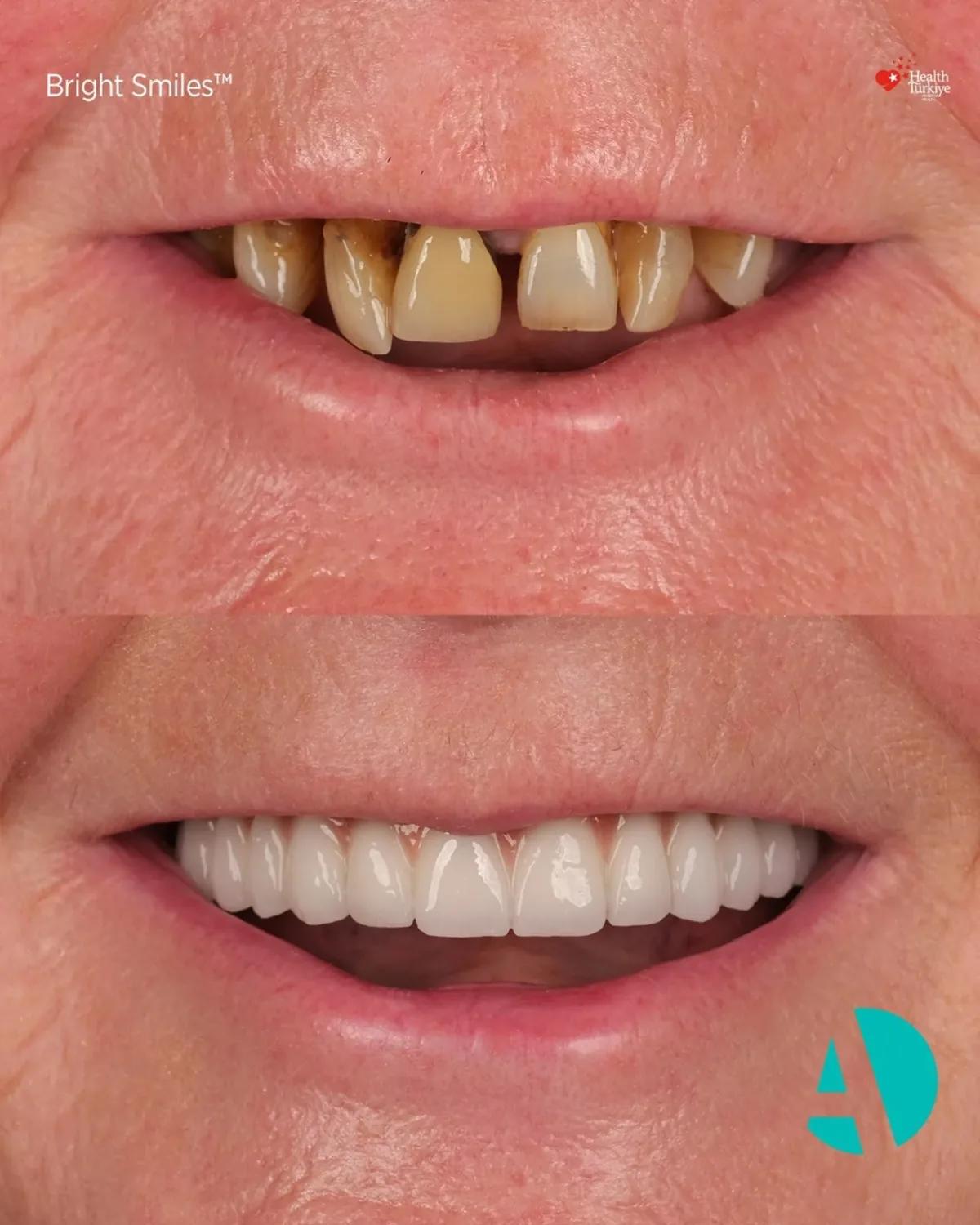Close-up smile before and after All-on-4 dental implants, patient one