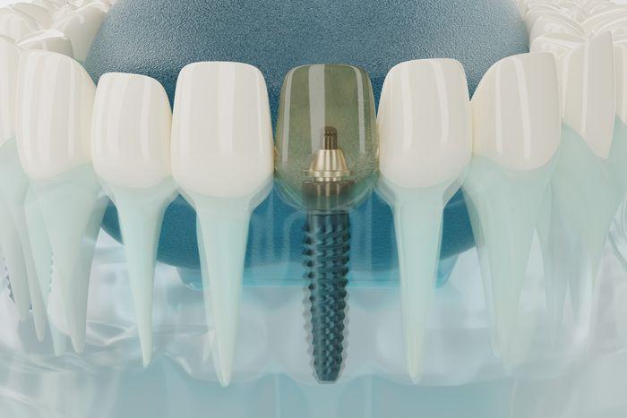 Transparent 3D model of teeth with one implant and crown