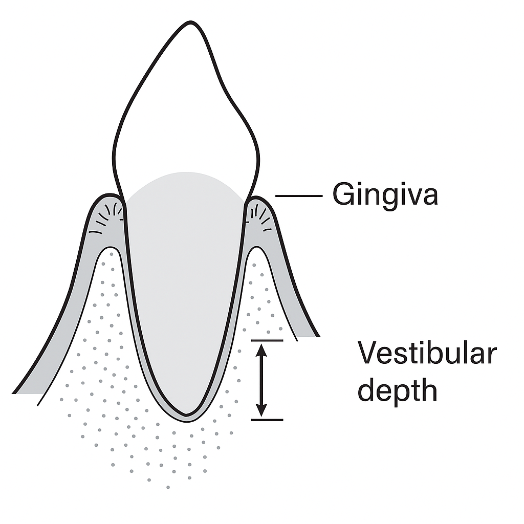 Diagram of a tooth with gingiva and vestibular depth labelled
