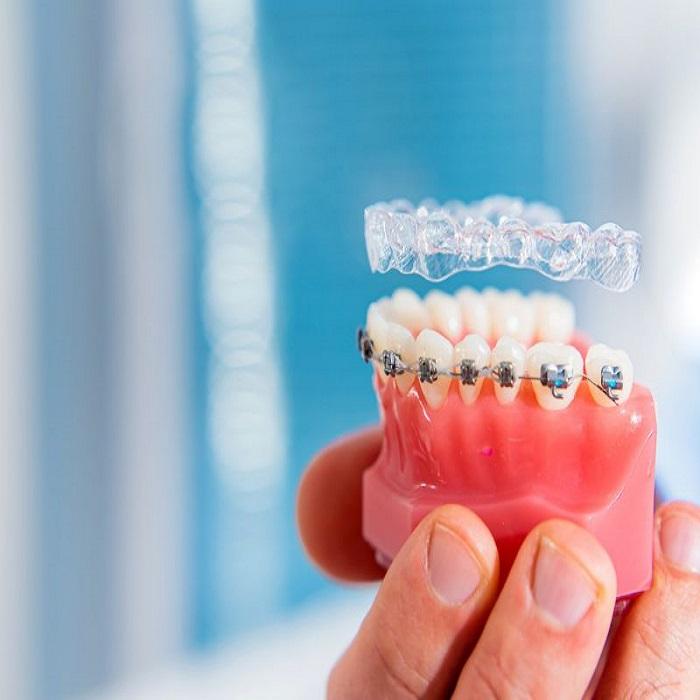Jaw model with braces and a clear aligner above it