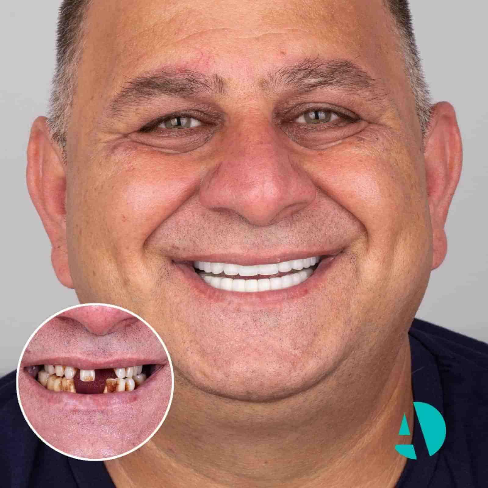 Before & after all-on-six all on 6 dental implants