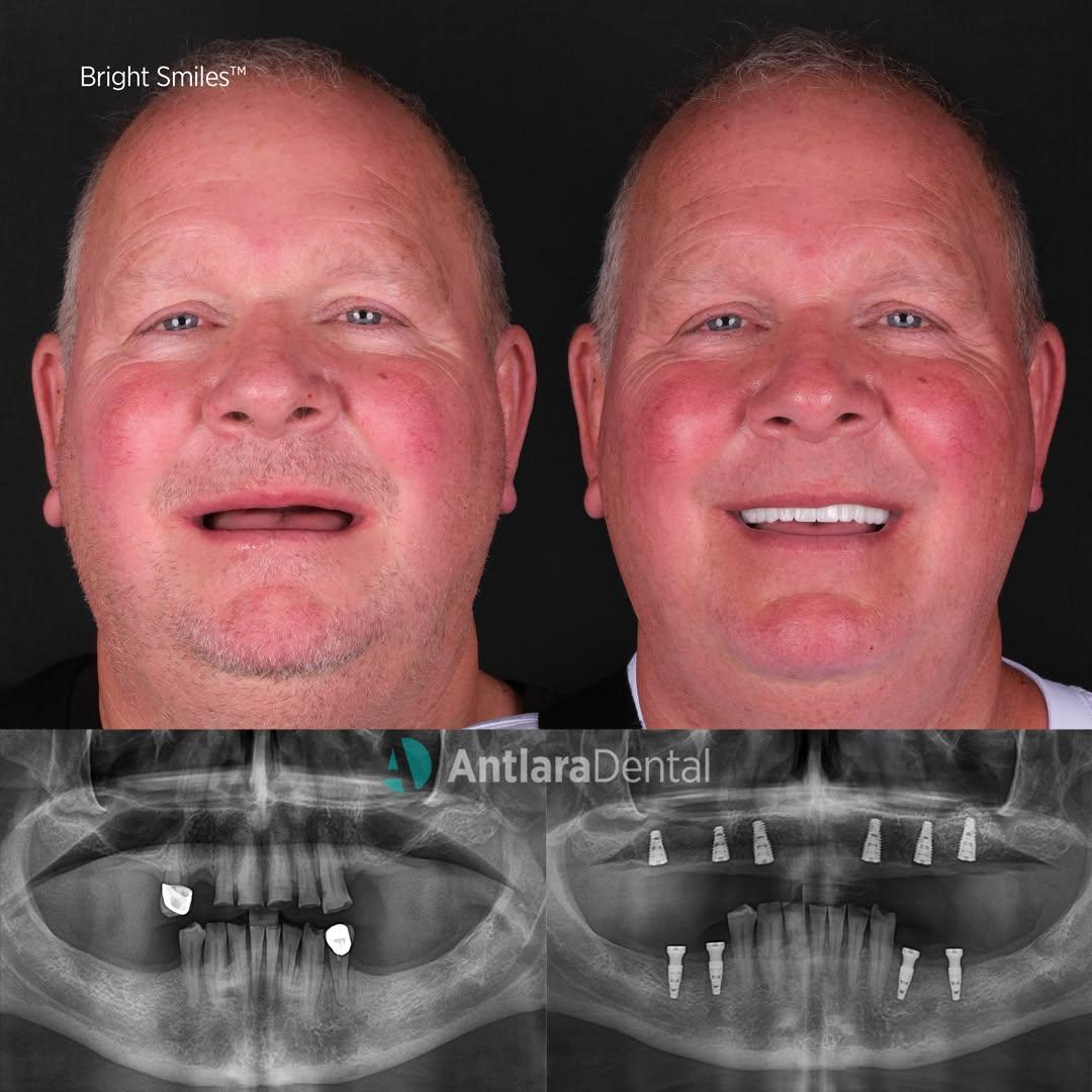 All on 6 dental implants before and after All on 6 dental implants before and after