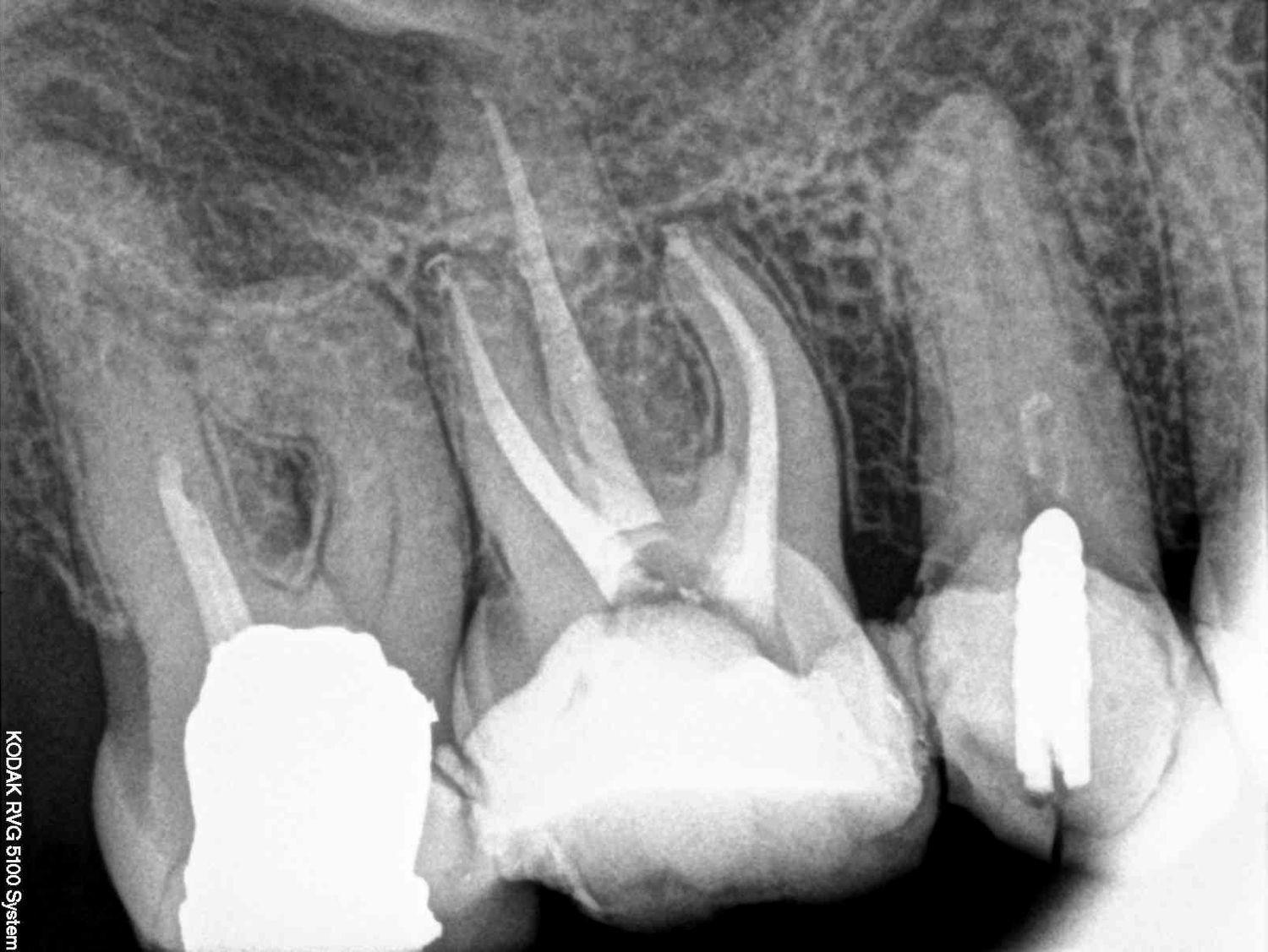 Dental X-ray of multi-rooted upper molars