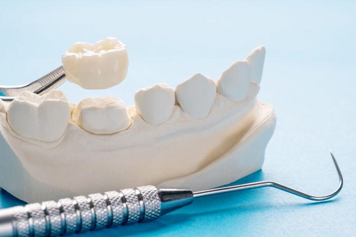 Crown held above a plaster jaw model with dental instruments