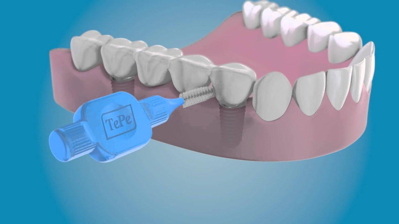 Render of an interdental brush cleaning beside an implant bridge