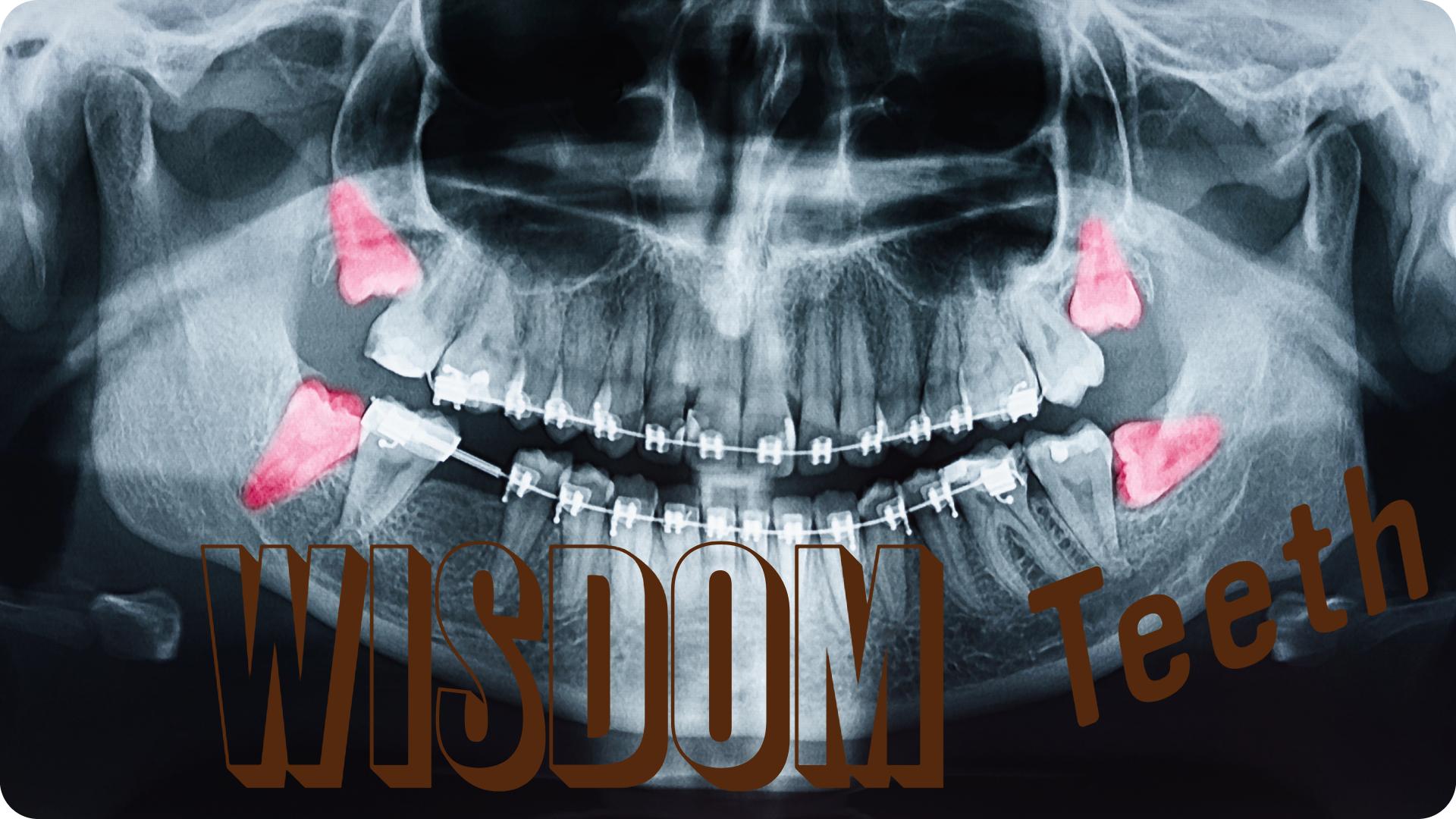 Panoramic x-ray with the four wisdom teeth highlighted