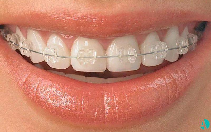Close-up of a smile with clear ceramic brackets and a wire