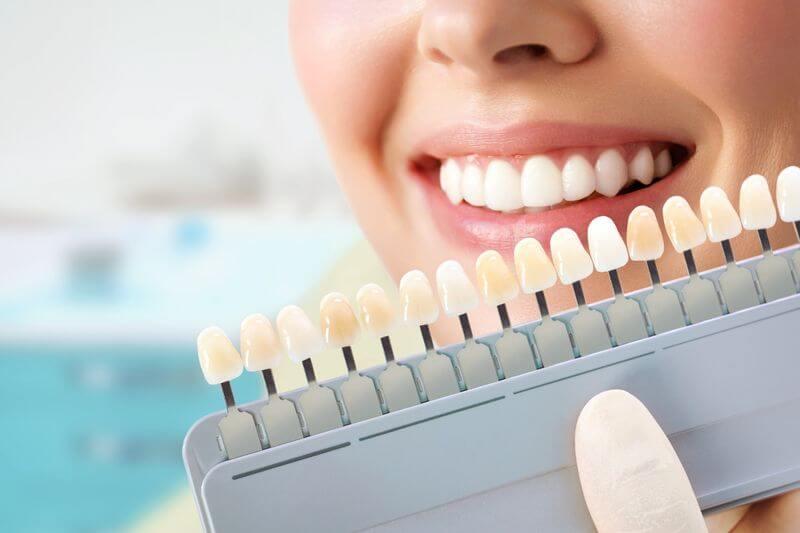 Tooth shade guide held beside a smile
