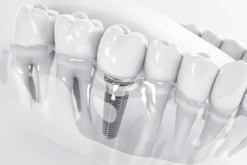 Transparent tooth model showing an implant screw under a crown