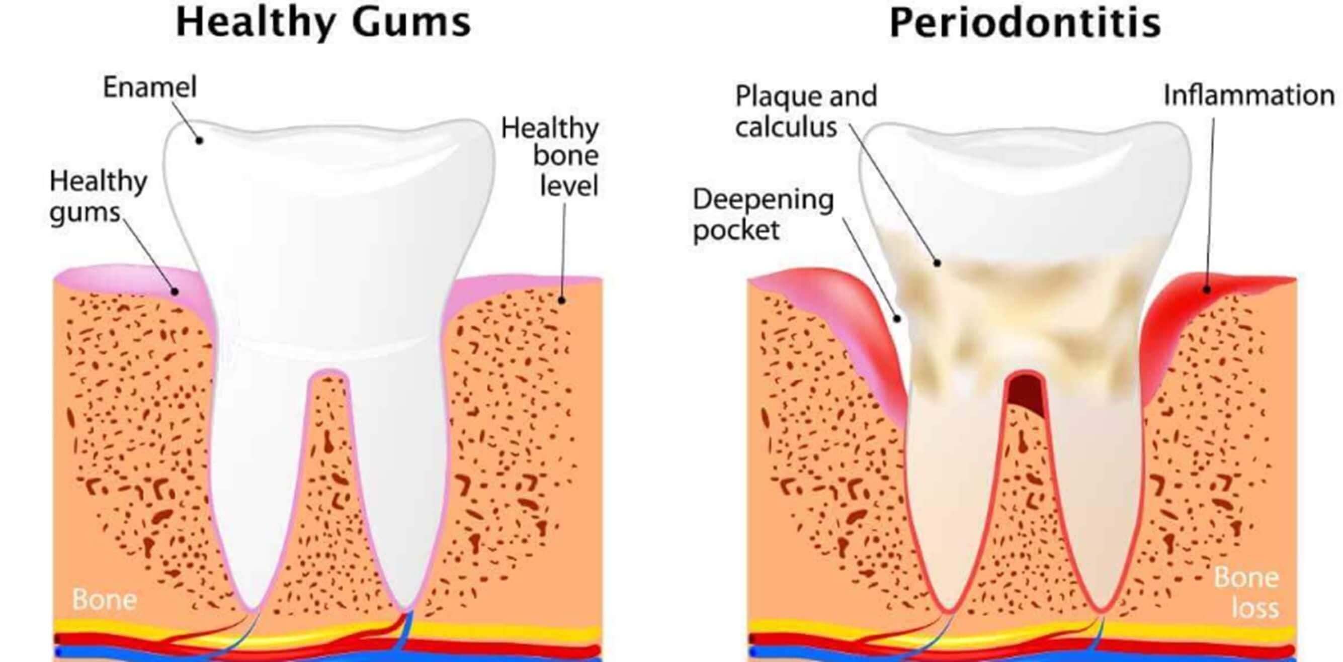 Diagram of healthy gums beside periodontitis with bone loss
