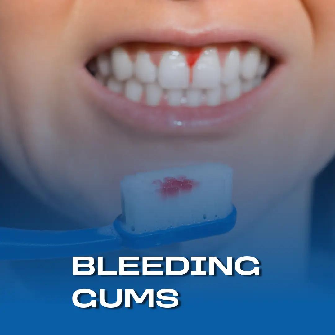 Teeth with a bleeding gum line and a toothbrush stained with blood