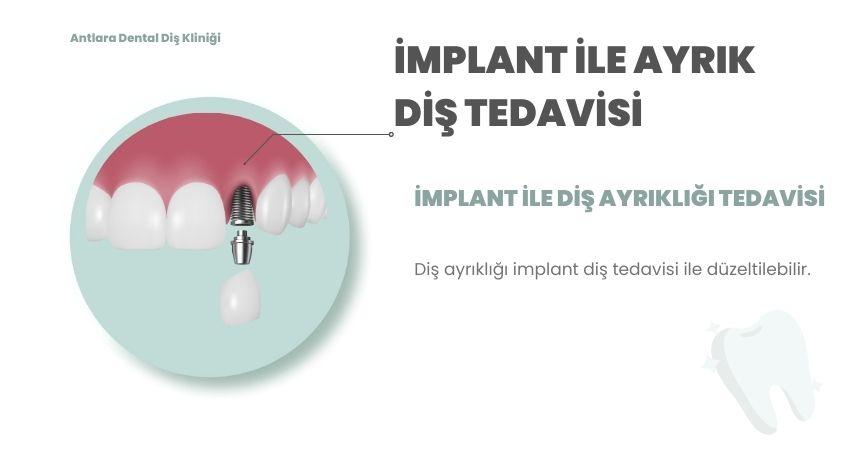 Implant, abutment ve kronu gösteren çizimli slayt