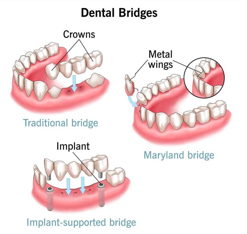 Illustration comparing traditional, Maryland and implant-supported bridges